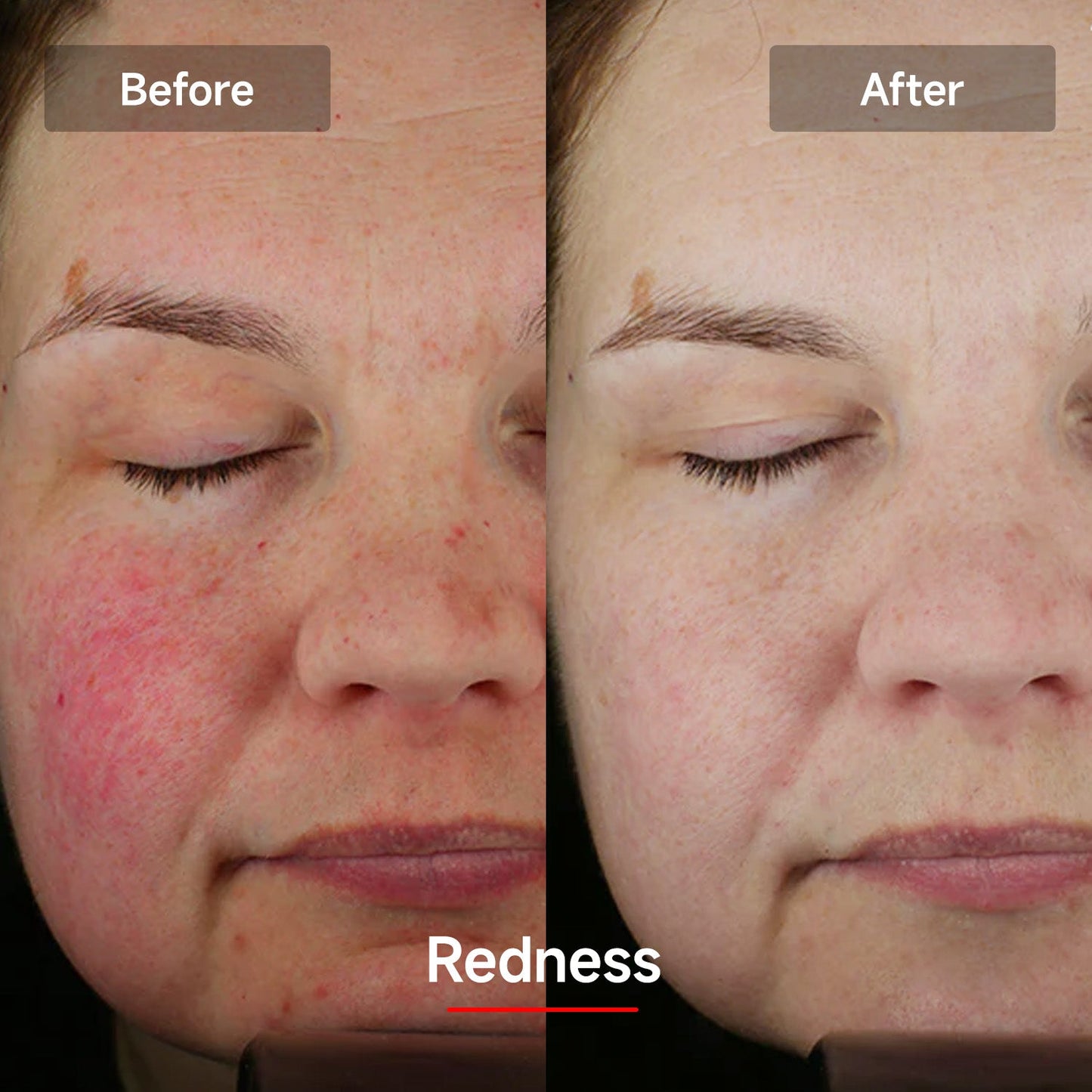 LASER&LED Light Therapy Mask