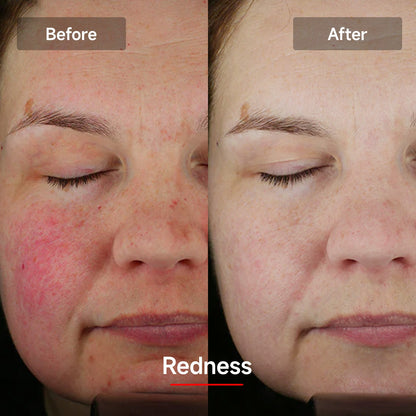 LASER&LED Light Therapy Mask