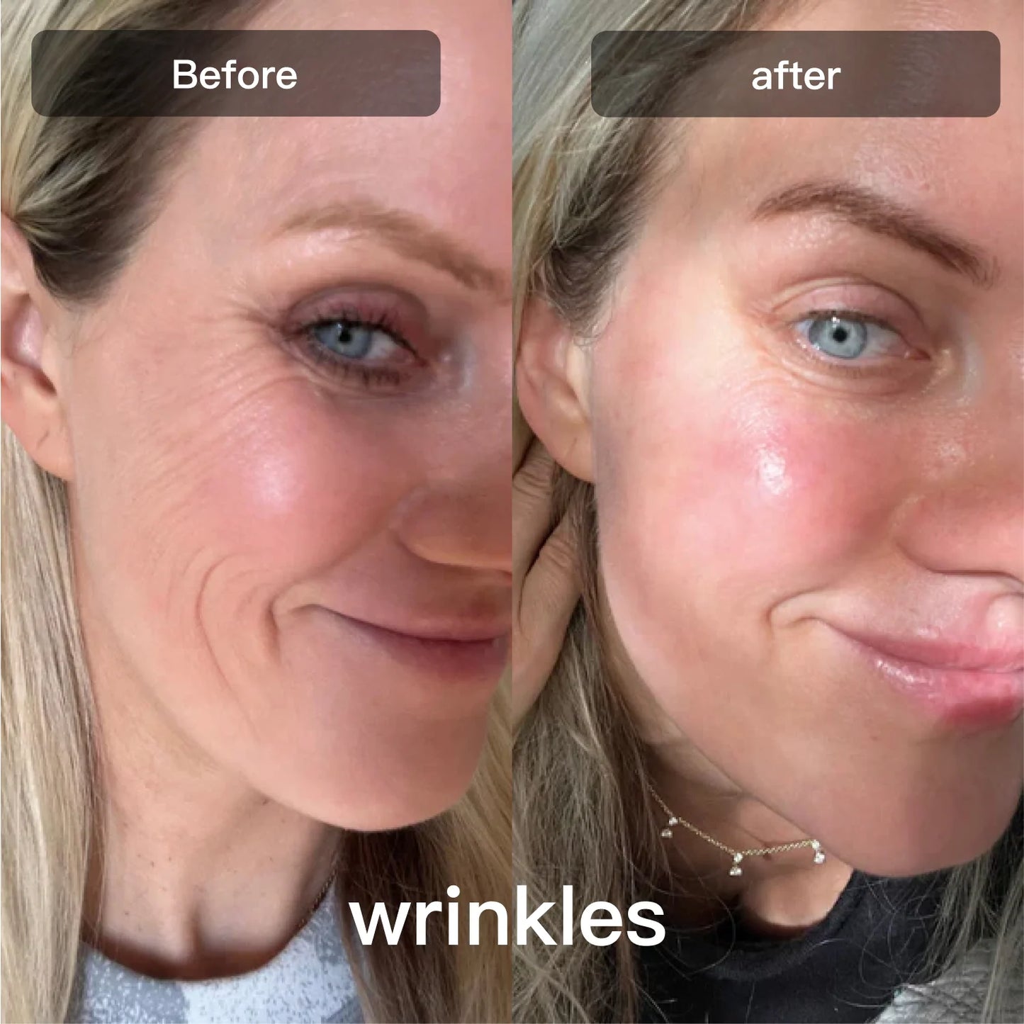 Veylixo LED Light Therapy Device